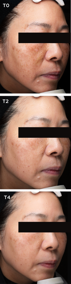 MELA BRIGHT Serum Sample | ALPHASCIENCE